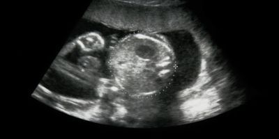 Photo of a human fetal ultrasound on a black background