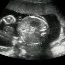 Photo of a human fetal ultrasound on a black background