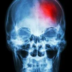 Photo of a human skull x-ray with the top right colored red to represent a stroke
