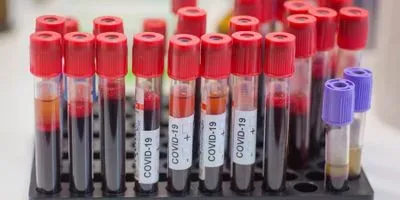 Photo of a rack of COVID-19 blood sample tubes
