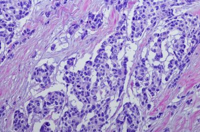 Study Finds Genetic Markers of Survival in Rare Childhood Cancer