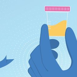 Urine Biomarkers Show Promise for Prostate Cancer Urine Biomarkers Show Promise for Prostate Cancer