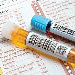 Photo of a tube containing a prostate cancer urinalysis sample