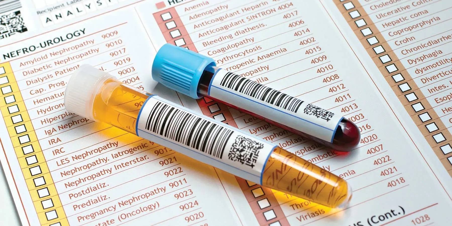 Photo of a tube containing a prostate cancer urinalysis sample