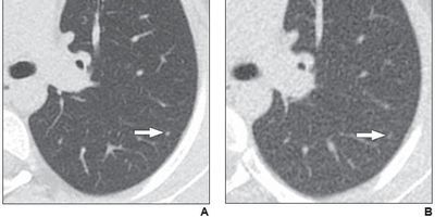 Axial reformatted clinical (1.083 mSv) and reduced dose (0.318 mSv) CT images from a 17-year-old girl with osteosarcoma. A 2 mm left lower lobe nodule is clearly visible in the left lower lobe on the clinical CT image (arrow in A). The same nodule is vaguely apparent on the reduced-dose CT image (arrow in B), classified as present but poorly visible.