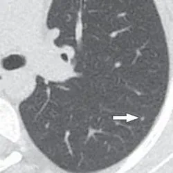 Axial reformatted clinical (1.083 mSv) and reduced dose (0.318 mSv) CT images from a 17-year-old girl with osteosarcoma. A 2 mm left lower lobe nodule is clearly visible in the left lower lobe on the clinical CT image (arrow in A). The same nodule is vaguely apparent on the reduced-dose CT image (arrow in B), classified as present but poorly visible.
