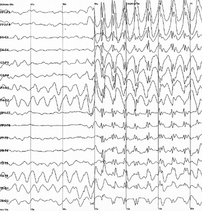 Novel Tool Used to Mine Clinical Data and Identify Causative Gene in Childhood Epilepsy