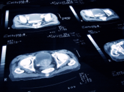 New Tool Predicts Outcomes of a Novel Treatment for Prostate Cancer