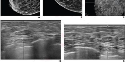 transverse (D), and reconstructed lateral (E) views from supplemental automatic breast ultrasound (ABUS) demonstrates 7 mm circumscribed slightly hypoechoic circumscribed lesion at 11 o'clock position in right breast. Lesion was classified as BI-RADS 3. Patient has undergone yearly mammograms for 4 years following the ABUS examination with no breast cancer diagnosis.