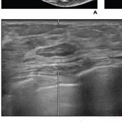 transverse (D), and reconstructed lateral (E) views from supplemental automatic breast ultrasound (ABUS) demonstrates 7 mm circumscribed slightly hypoechoic circumscribed lesion at 11 o'clock position in right breast. Lesion was classified as BI-RADS 3. Patient has undergone yearly mammograms for 4 years following the ABUS examination with no breast cancer diagnosis.