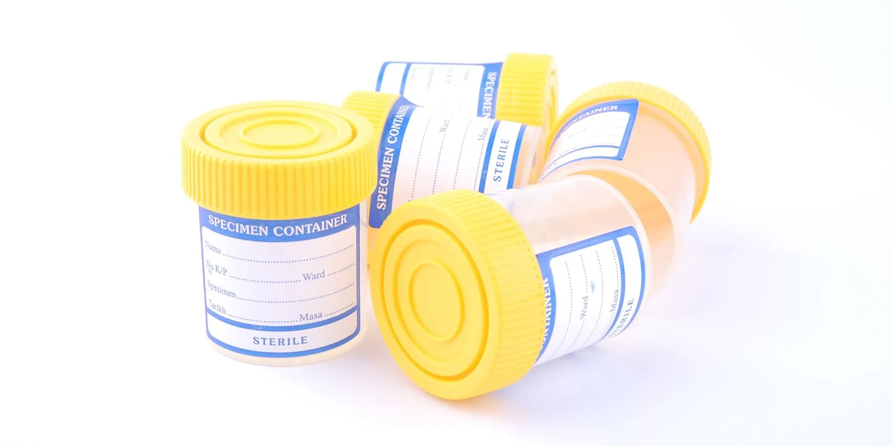 Preoperative Screening Urinalysis Is Widely Used—but Usually Unnecessary Image of speciman containers for urin