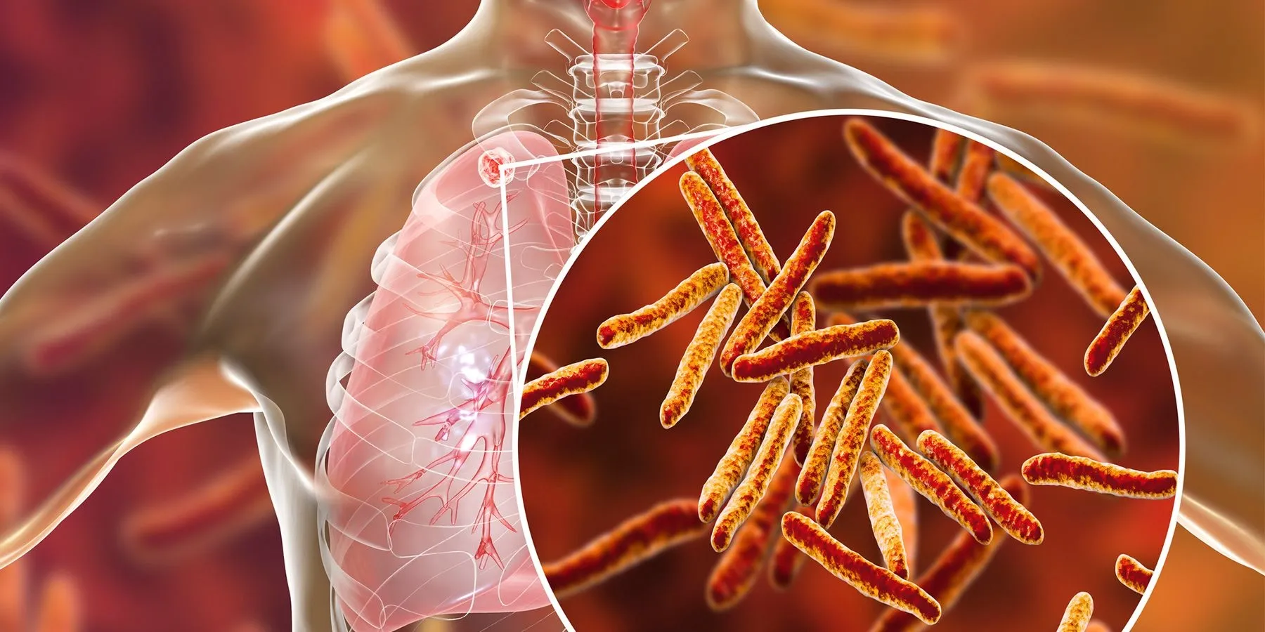 3D image of human lungs with Tuberculosis