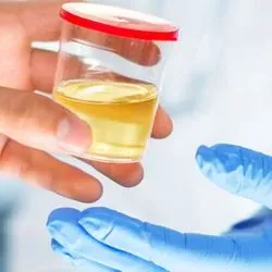 Urine sample being handed over for analysis