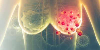 Computer image of an x-ray showing a woman with breast cancer