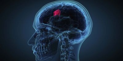 Computer image of a human brain with a tumor