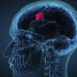 Computer image of a human brain with a tumor