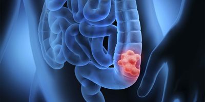 Computer image of a human coloon with cancer