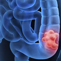 Computer image of a human coloon with cancer