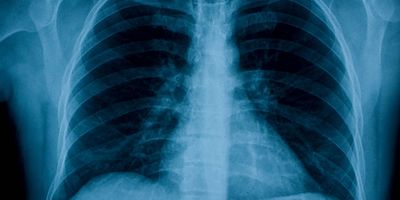 A chest x-ray of a human