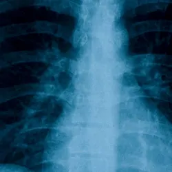 A chest x-ray of a human