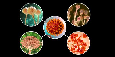 Opportunistic fungal infections present new challenges to health care providers on the front line of the COVID-19 pandemic