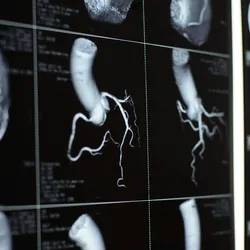 MRI images of heart and blood vessels 