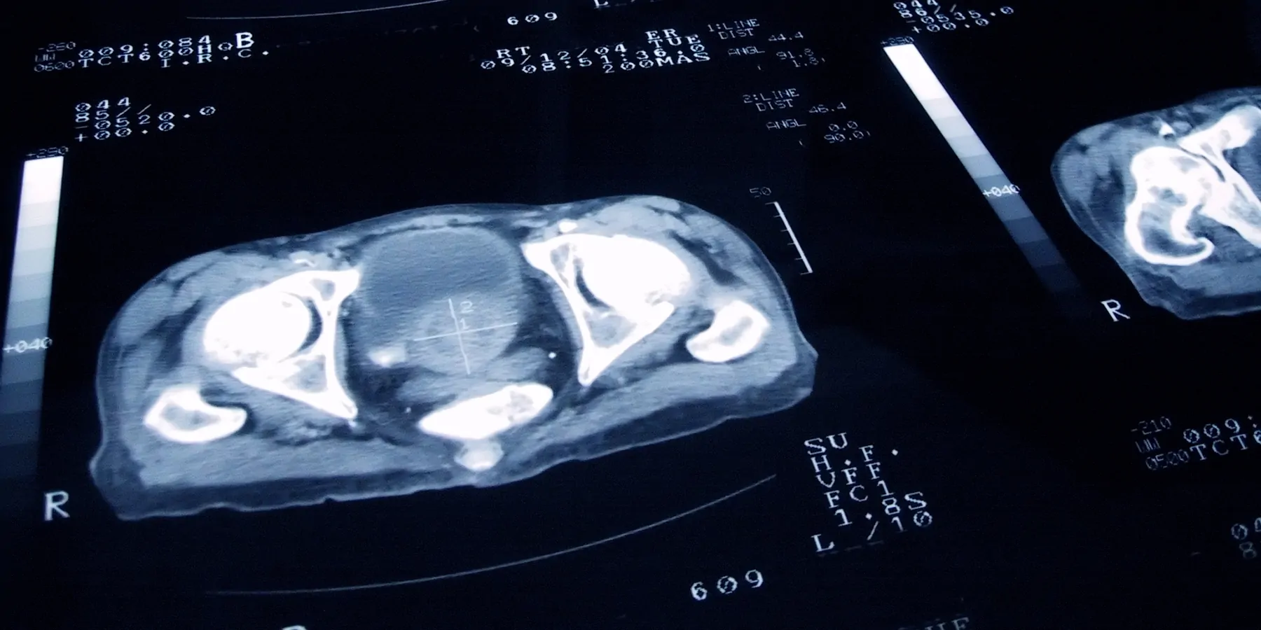 Imaging of a human with prostate cancer