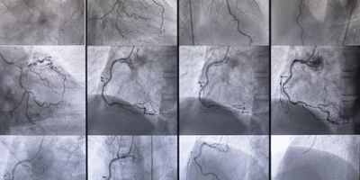 Coronary angiography , left and right coronary angiography stock photo