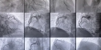 Coronary angiography , left and right coronary angiography stock photo