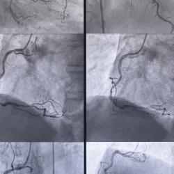 Coronary angiography , left and right coronary angiography stock photo
