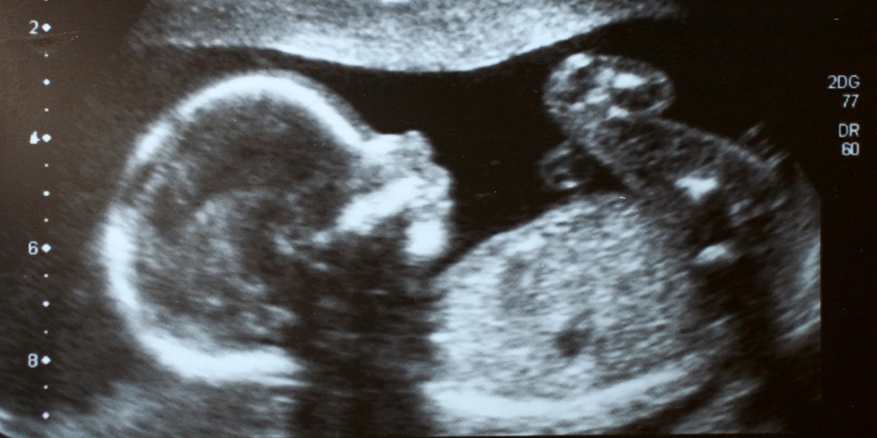 COVID-19 Vaccine Not Associated with Birth Defects Detectable on Ultrasound ultrasound of a healthy human embryo