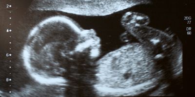 ultrasound of a healthy human embryo