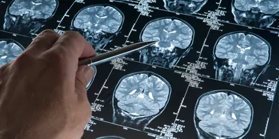 Person pointing with a pen to a brain scan of a human brain