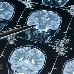 Person pointing with a pen to a brain scan of a human brain