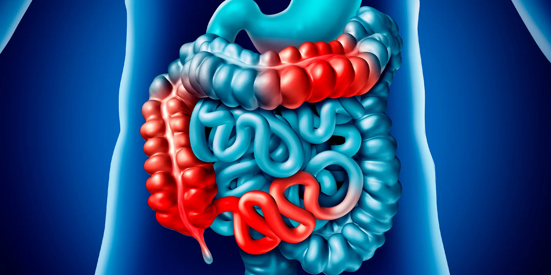 Computer image of a human intestine with red patches to indicate disease