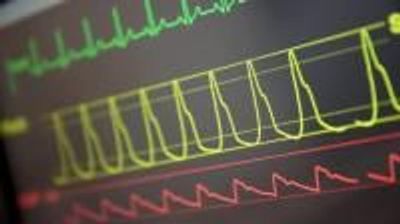 Algorithm Uses Disease History to Predict Intensive Care Patients&#39; Chances of Survival
