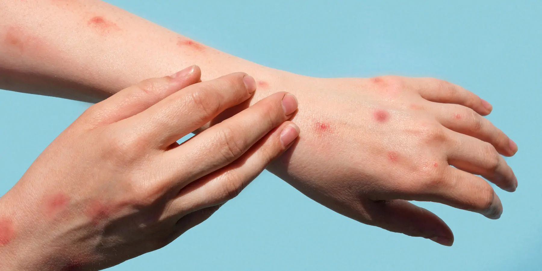 Person with monkey pox on arms, scratching