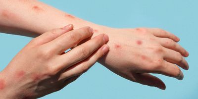 Person with monkey pox on arms, scratching