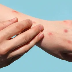 Person with monkey pox on arms, scratching