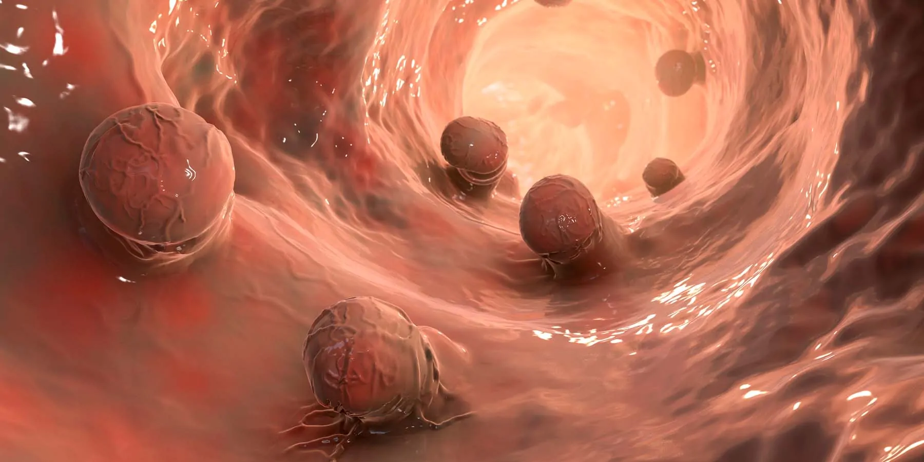 Computer image of cancer polyps