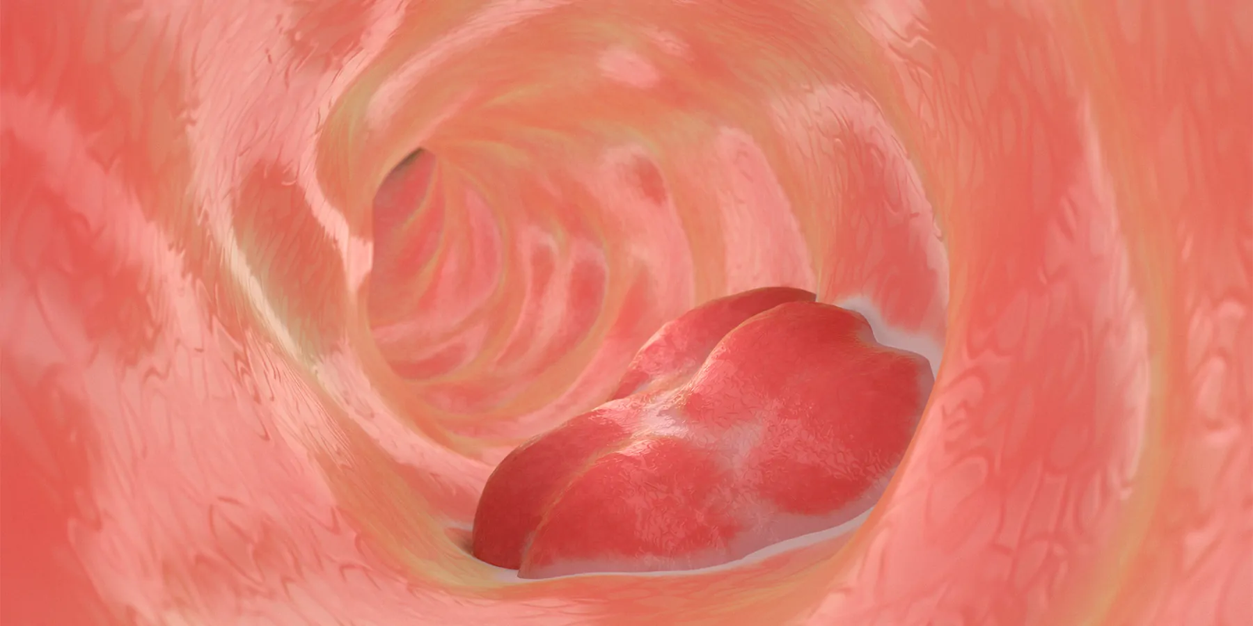 Image of colorectal cancer, thought to be cured with dostarlimab. 