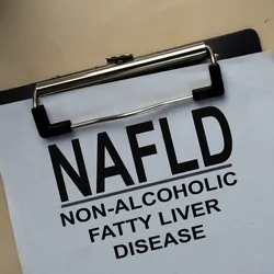 NAFLD - Non-Alcoholic Fatty Liver Disease write on a paperwork isolated on office desk