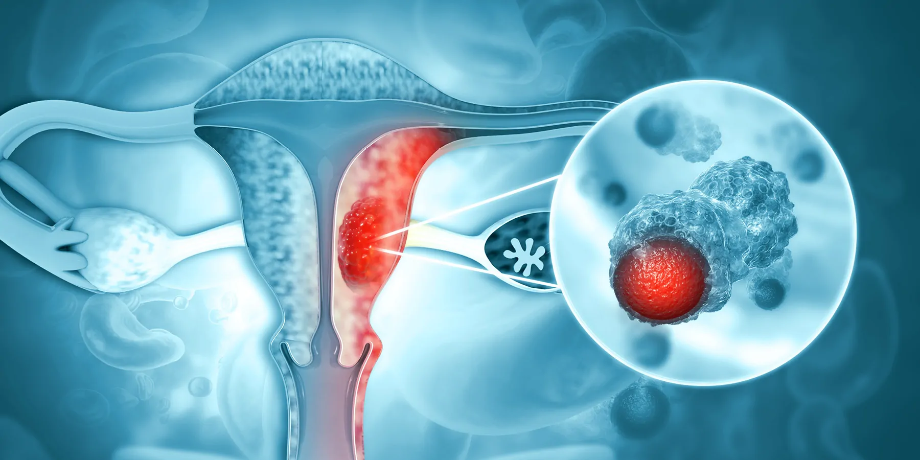 Computer render of cervix and uterus with red cancer cells 