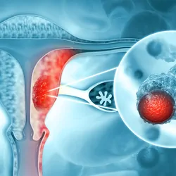 Computer render of cervix and uterus with red cancer cells
