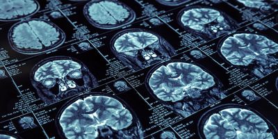 Closeup of X-ray photography of human brain 