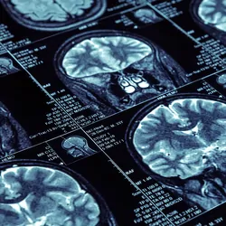 Closeup of X-ray photography of human brain 