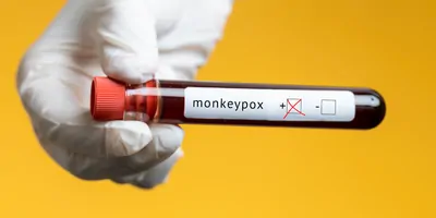 Photo of a blood sample labeled as positive for monkeypox