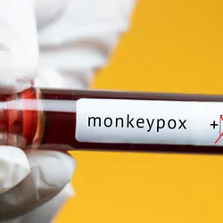Photo of a blood sample labeled as positive for monkeypox