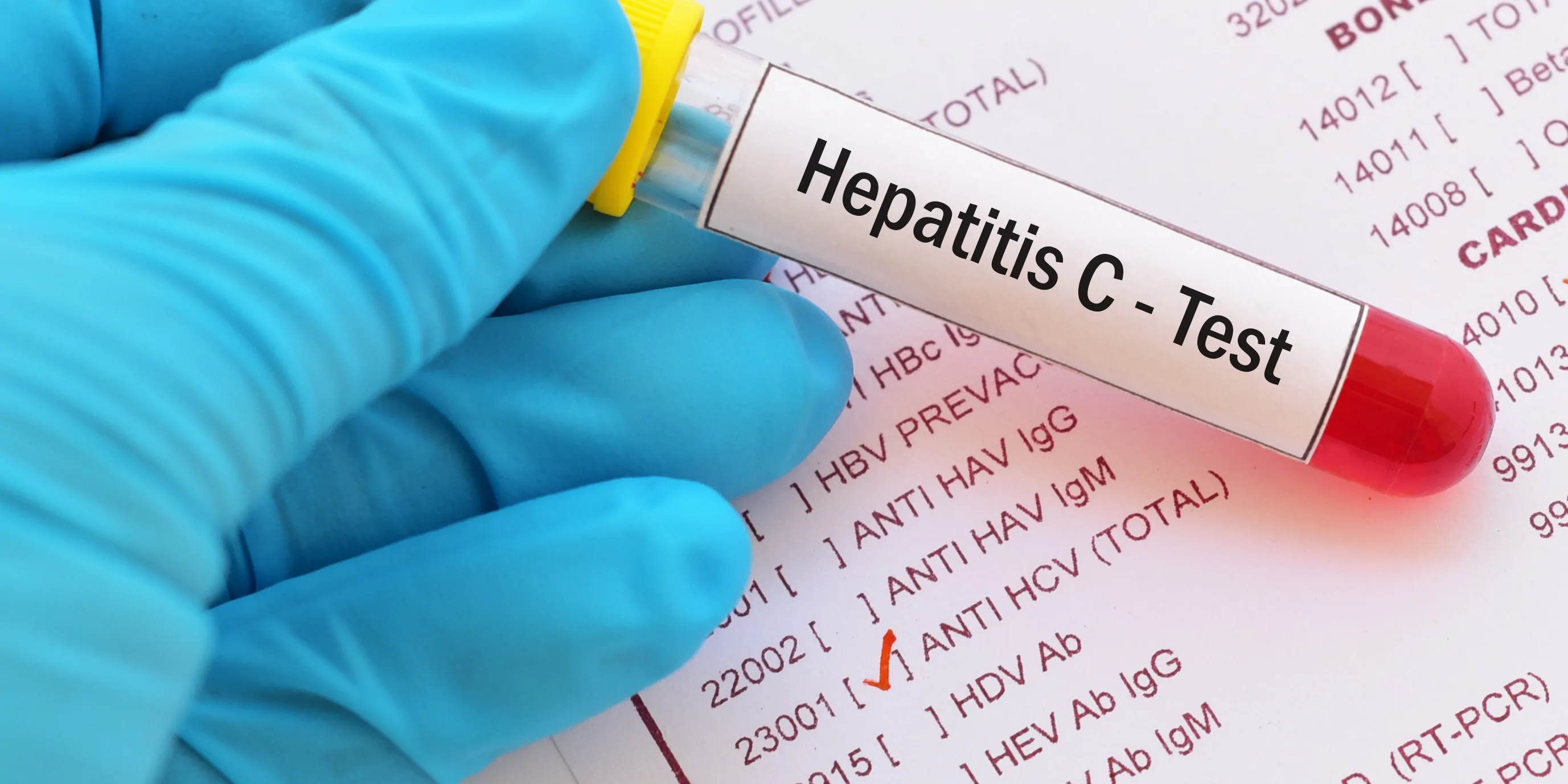 Test tube with blood sample for hepatitis C virus