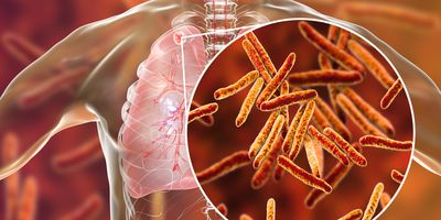 Secondary tuberculosis in lungs and close-up view of Mycobacterium tuberculosis bacteria, 3D illustration